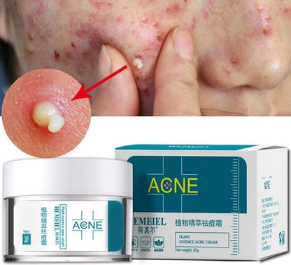 Acne Cream – Powerful Treatment for Clear, Blemish-Free Skin